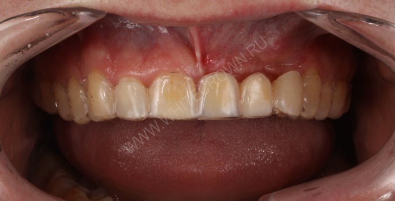 Essix retainer with teeth