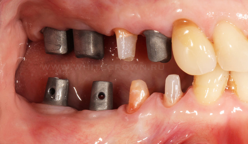 протезирование боковых зубов