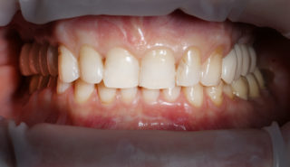 Какой имплантат поставить на жевательный зуб?