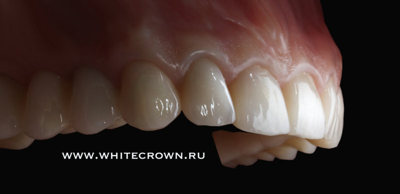 Какой имплантат поставить на жевательный зуб?