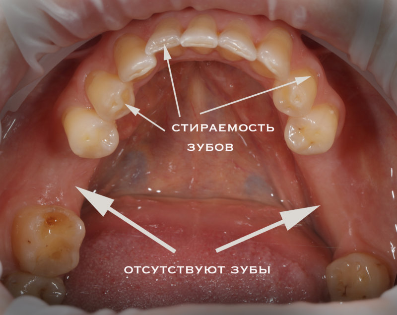 истираемость зубов