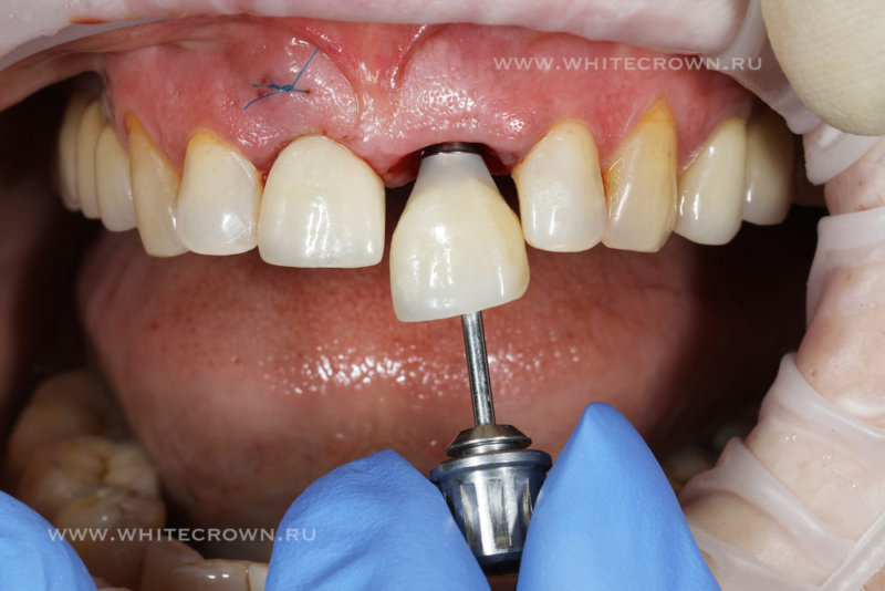 как установить имплантат на передний зуб и не ходить без зуба?